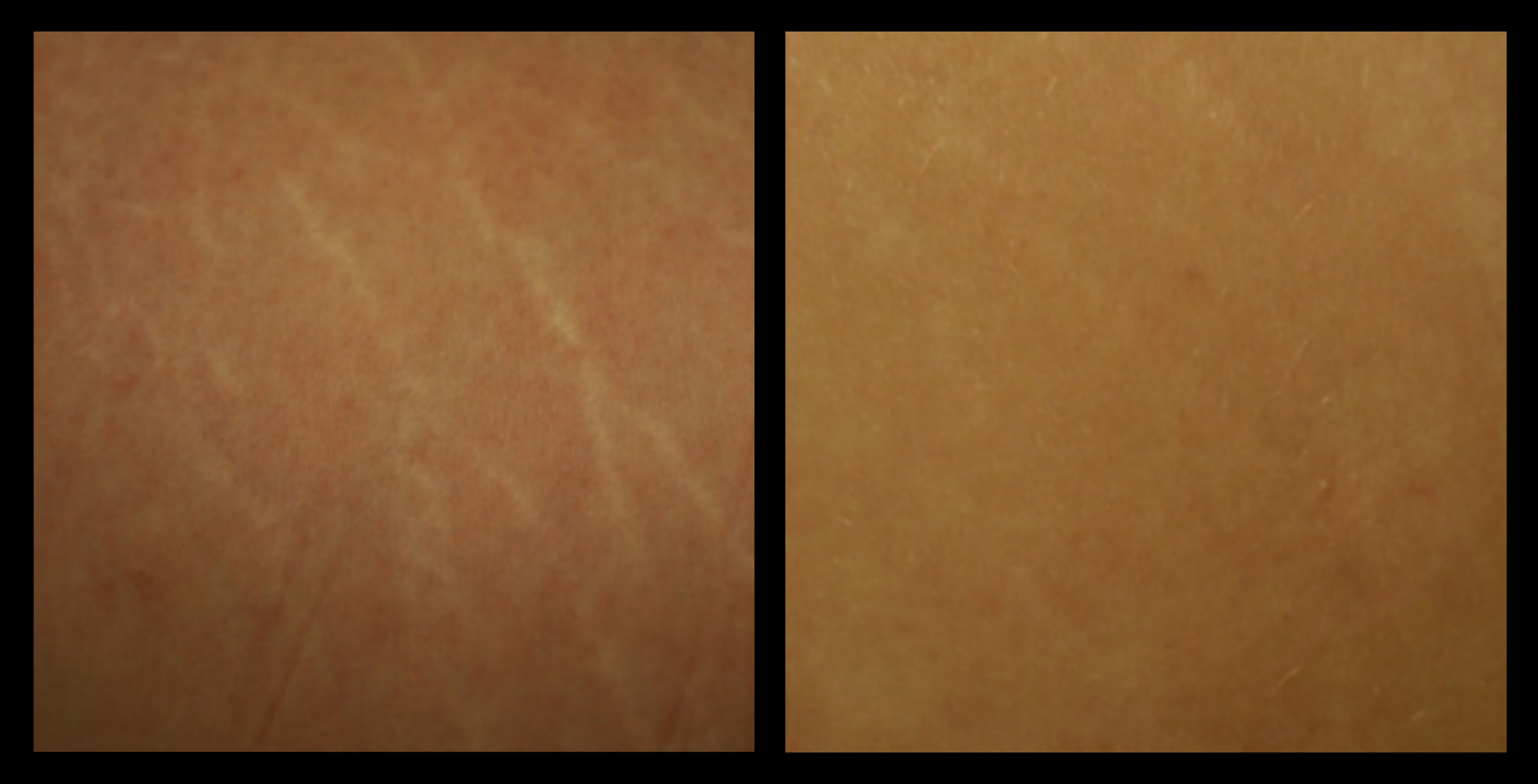 XCellaris PRO TWIST microneedling results showing enhanced skin smoothness and radiance. Powered by Dermaroller® technology, this professional treatment targets uneven skin tone, texture irregularities, and signs of ageing for visibly rejuvenated skin.