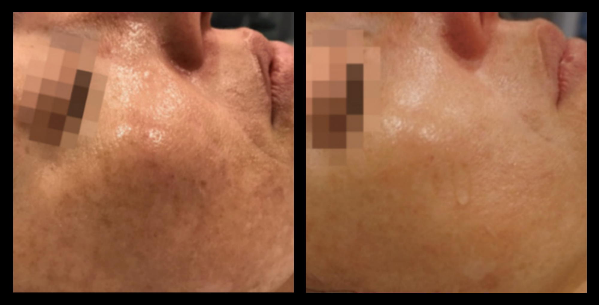 XCellaris PRO TWIST microneedling results on client’s face showing visibly refined pores, smoother texture, and improved skin tone. Professional Dermaroller® technology used for advanced facial rejuvenation, collagen stimulation, and enhanced skin clarity.