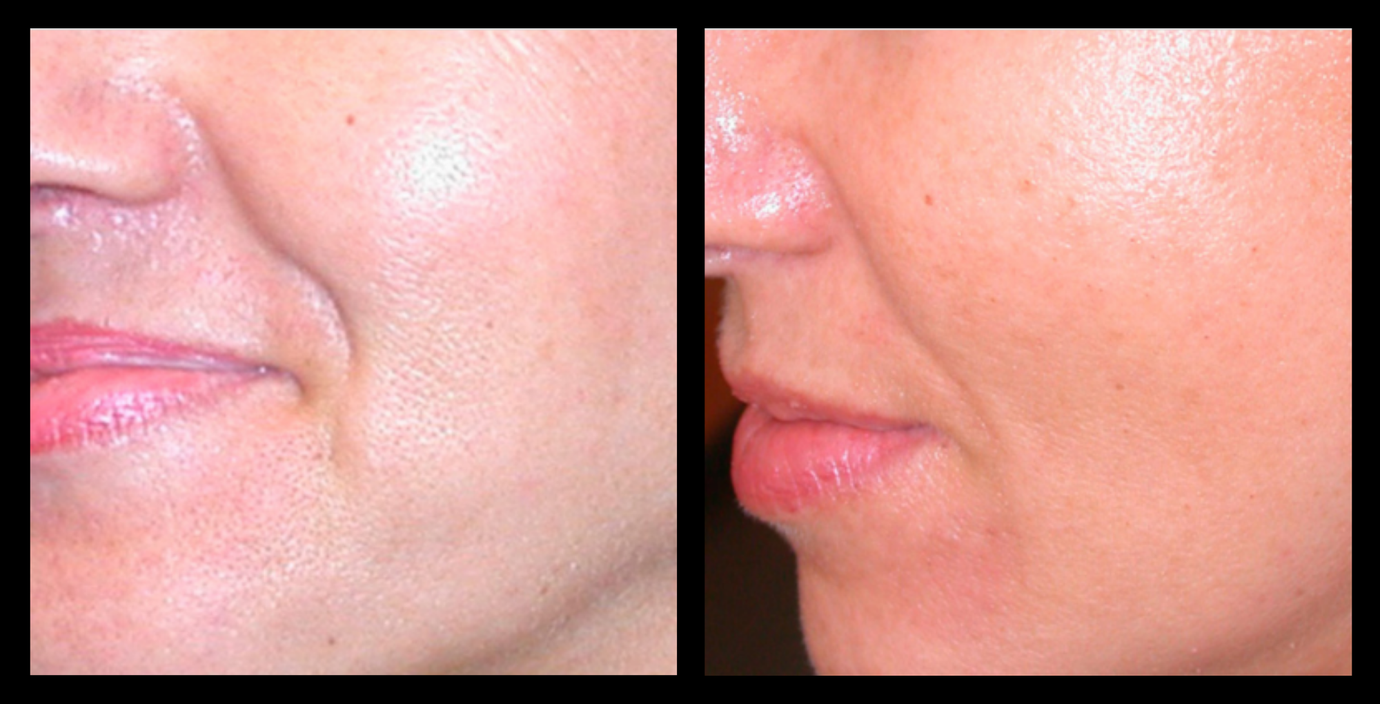XCellaris PRO TWIST microneedling results on client’s face showing visibly refined pores, smoother texture, and improved skin tone. Professional Dermaroller® technology used for advanced facial rejuvenation, collagen stimulation, and enhanced skin clarity.