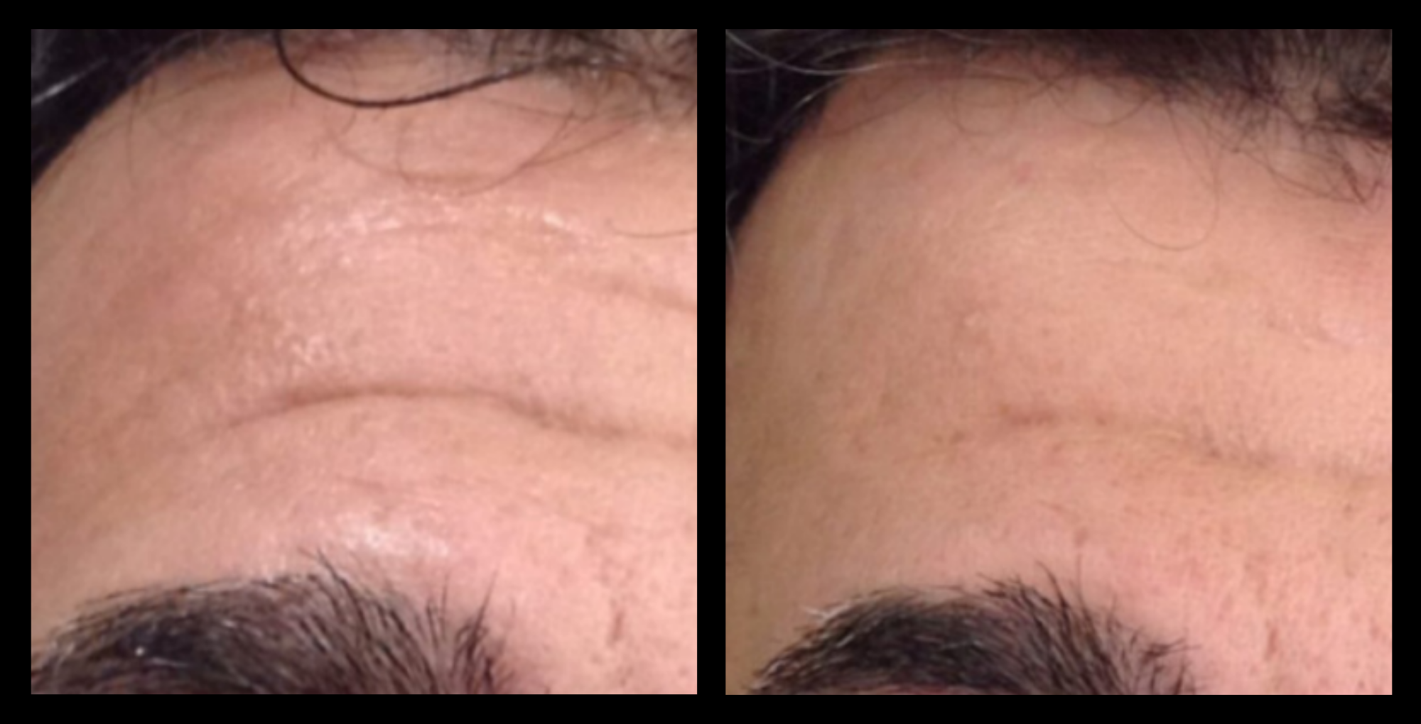 XCellaris PRO TWIST microneedling results on client’s forehead showing visibly smoother skin, reduced texture irregularities, and enhanced clarity. Powered by Dermaroller® technology for targeted forehead rejuvenation and professional-grade skin renewal.