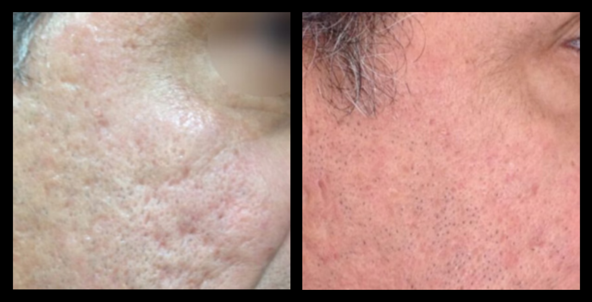 XCellaris PRO TWIST microneedling results on client’s cheeks showing improved skin texture, enhanced smoothness, and a more radiant complexion. Utilises Dermaroller® technology for targeted facial rejuvenation and collagen-boosting treatment.