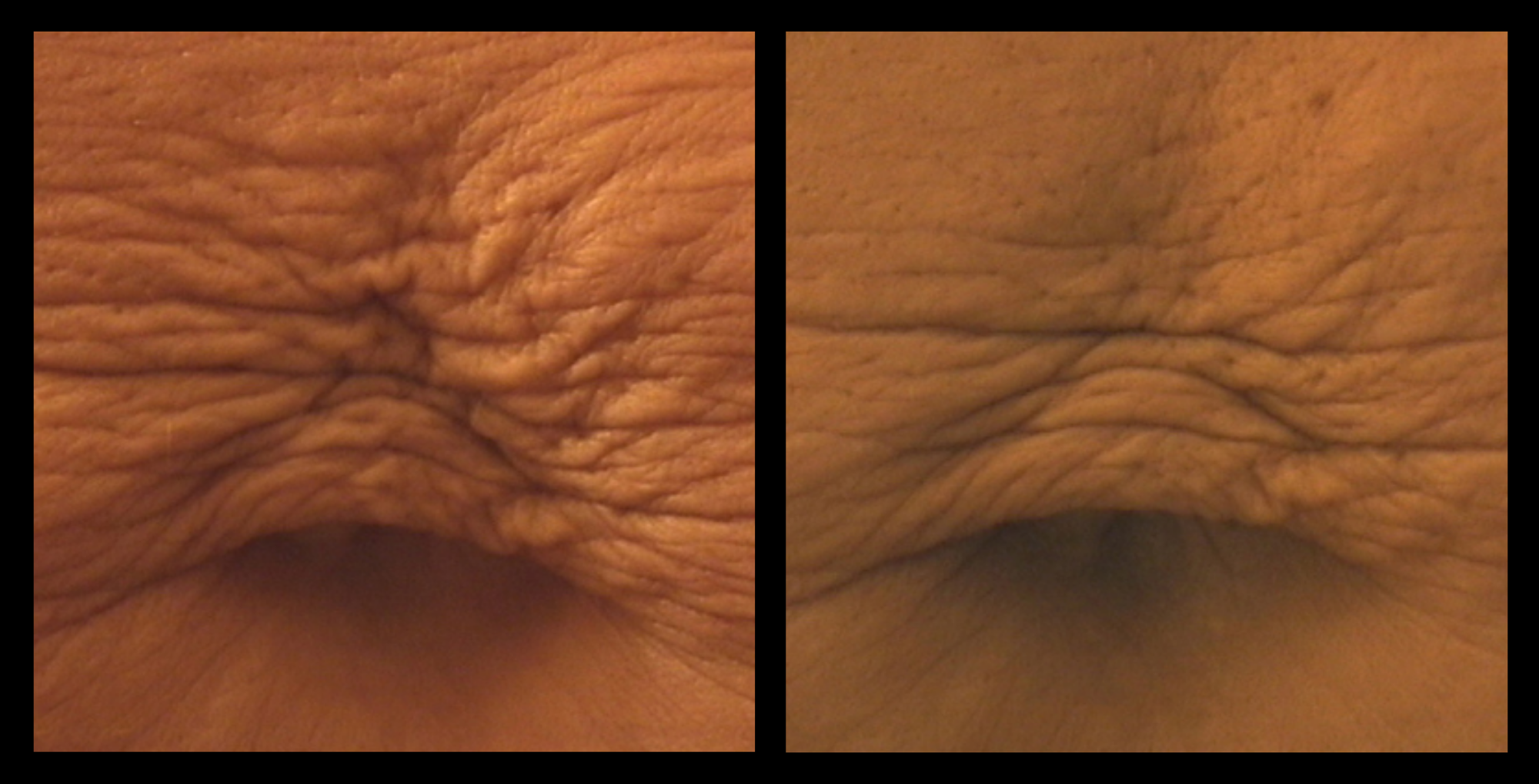XCellaris PRO TWIST microneedling results showcasing smoother, more refined skin with enhanced tone and radiance. Professional treatment using Dermaroller® technology designed to support collagen production and visible skin rejuvenation.