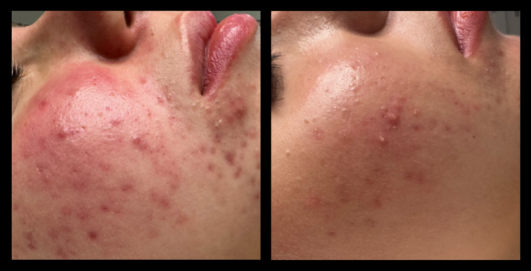 IPL Acne Management Results After 6 Treatments. Photo courtesy of Exquise Skin Boutique, Harrington Park, NSW.