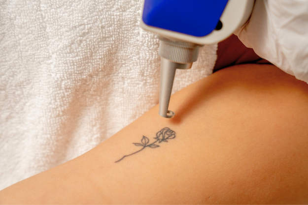 ULTRALASE laser tattoo removal machine technology treatment on the arm