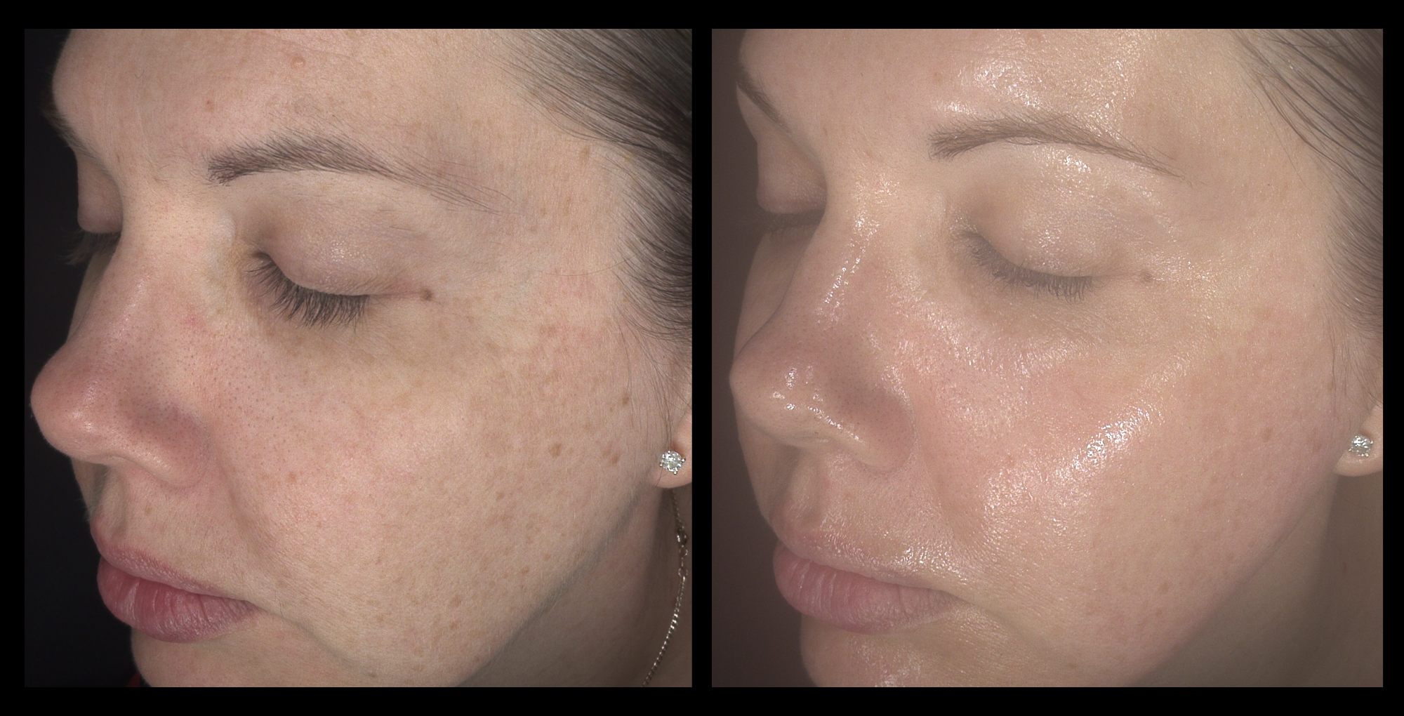 Before and after results of Carbon Facial, IPL Photo Rejuvenation, and RF Skin Tightening after 1 treatment, showing visibly clearer, smoother, and tighter skin. Photo courtesy of Rural Body & Beauty, Coolalinga, NT.