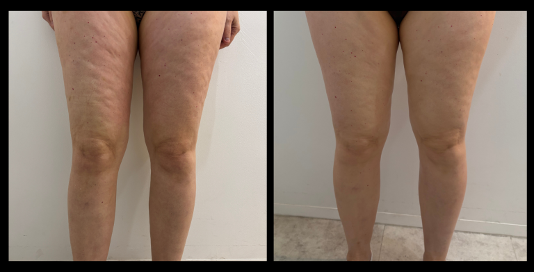 Before and after results of Ultrasound Body Contouring and RF Skin Tightening after 1 treatment, showing visible reduction in fat and improved skin firmness around the smile lines. Results courtesy of Beauty Hub Sydney, NSW.
