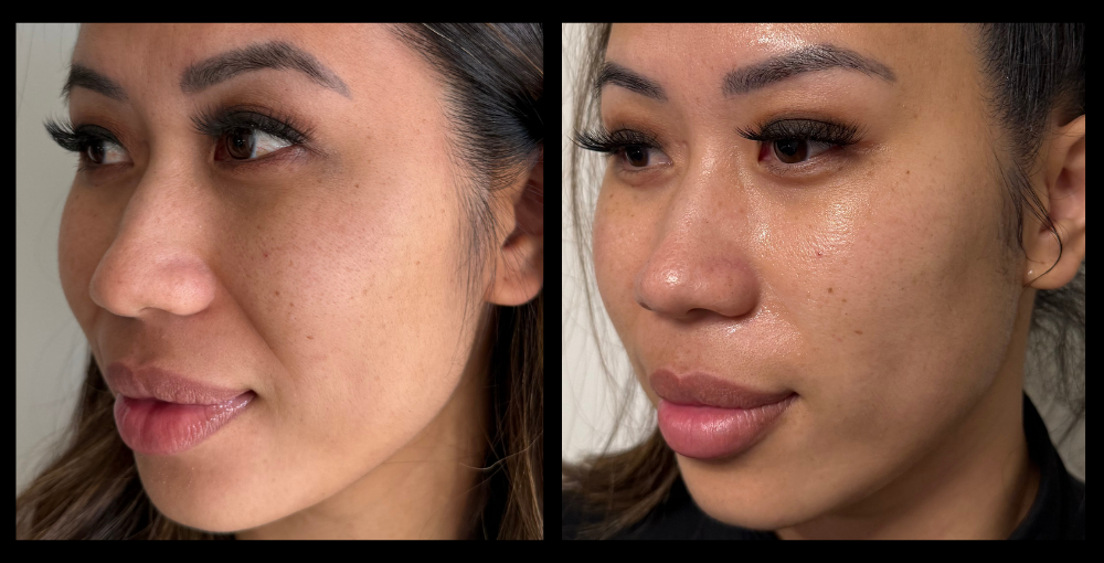 Before and after results of HIFU Non-Surgical Face Lift after 1 treatment, showing visible improvement in smile lines and overall skin firmness. Results courtesy of Flawless in You, Dayton, WA.