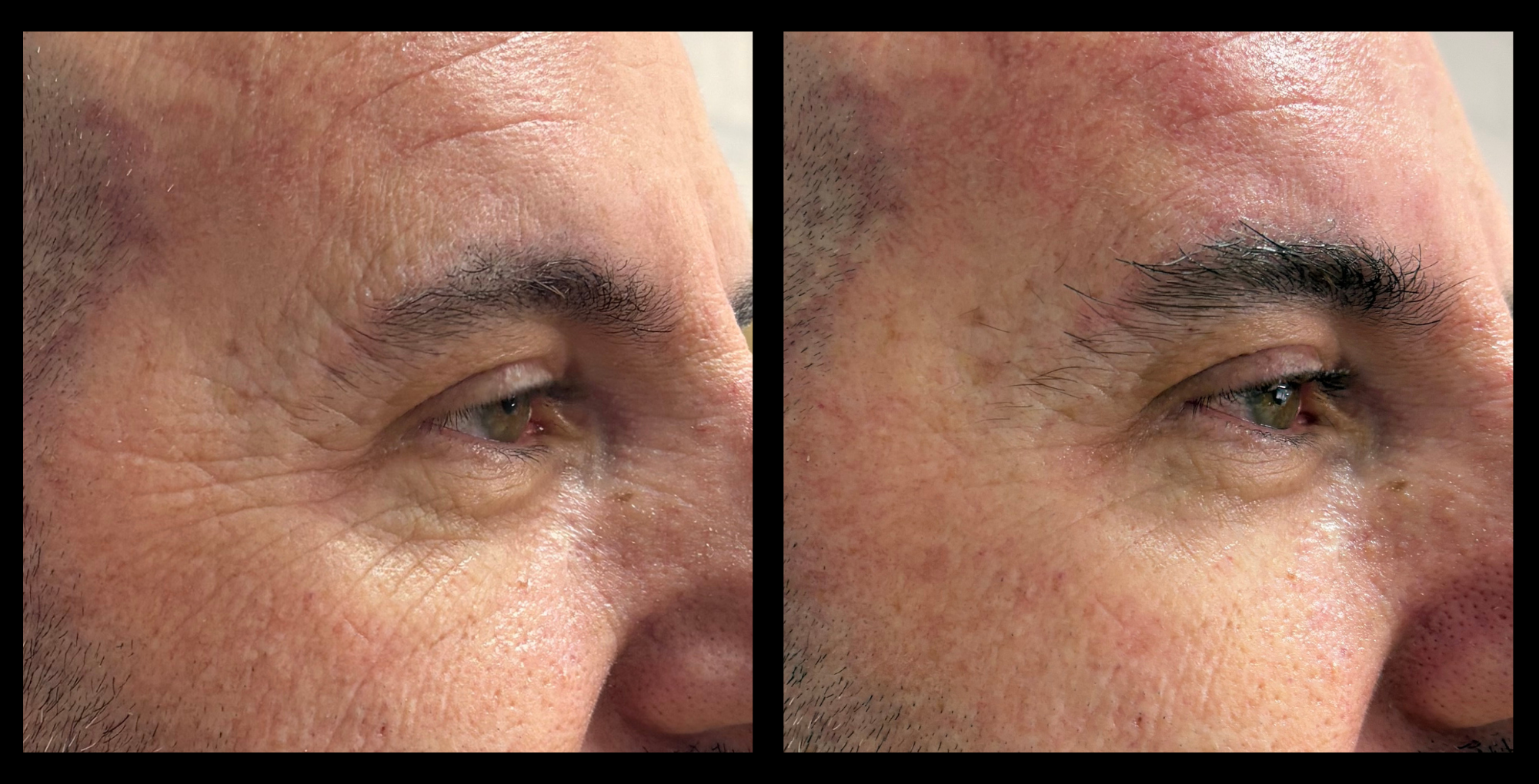 Before and after results of HIFU Non-Surgical Face Lift after 2 treatments, highlighting visible softening of eye lines and improved skin tightness. Results courtesy of Loyal Beauty and Grooming, Scarborough, WA.