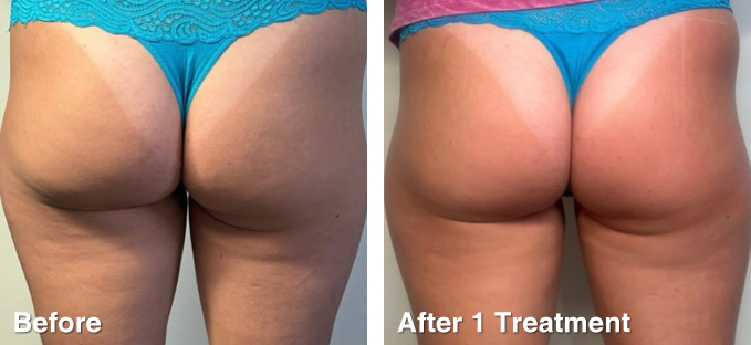 RF Skin Tightening After 1 Treatment. Photo courtesy of Beauty Room By Tiannah Paige, NSW.