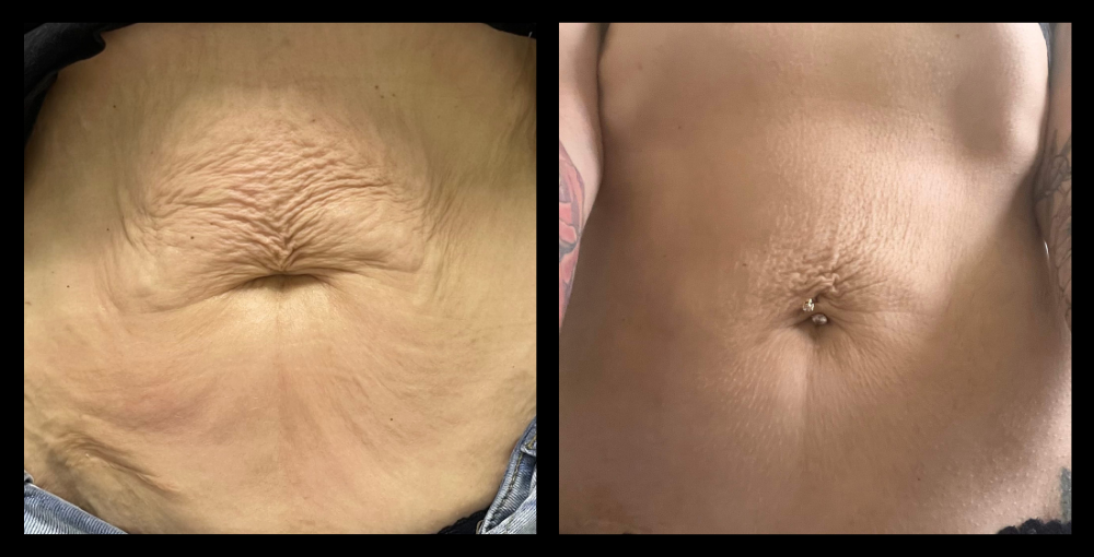 Before and after photos of RF Skin Tightening results after 10 treatments, showing visibly firmer, smoother, and more toned skin around the face. Results courtesy of Vanity Hair and Body, Walkley Heights, SA.