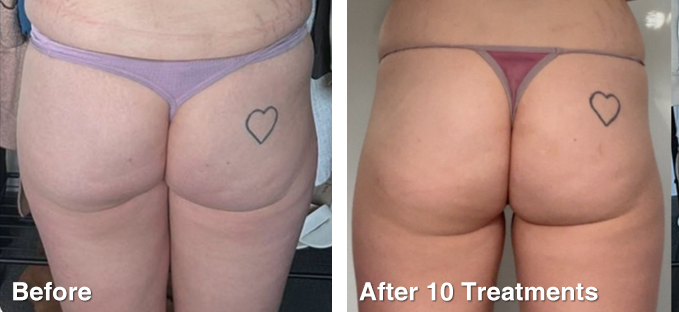 Ultrasound Body Contouring After 10 Treatments. Photo courtesy of Beauty Room By Tiannah Paige, NSW.