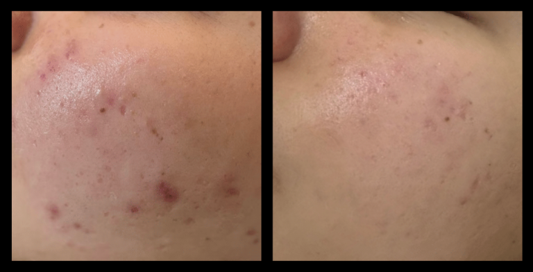 Fractional RF Skin Resurfacing device before and after 1 treatment—visible improvement in skin tone, texture, and fine lines. Non-invasive facial rejuvenation results. Photo courtesy of Beauty Hub Sydney.