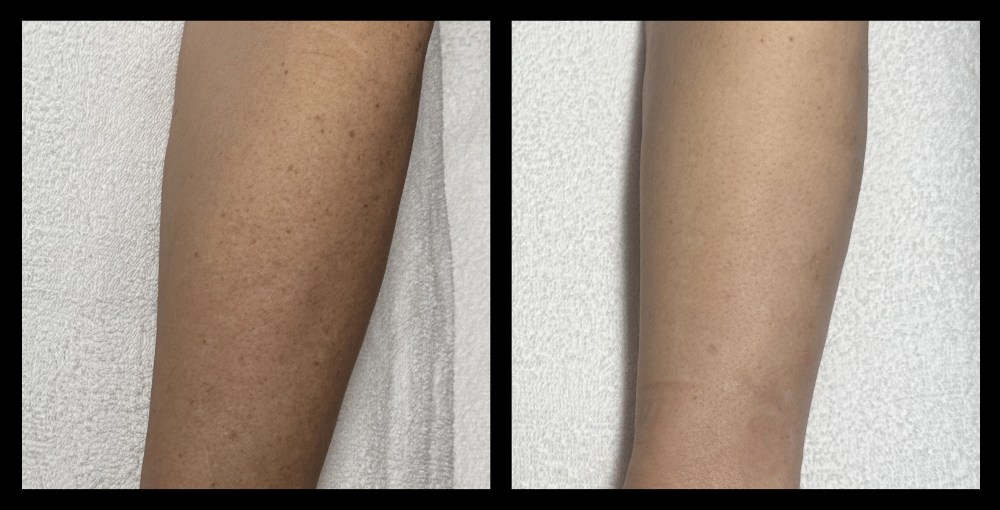 IPL Pigmentation Correction before and after photo showing improved skin clarity and reduced dark spots after 2 treatments. Courtesy of 23 Therapies, Pukekohe, NZ.