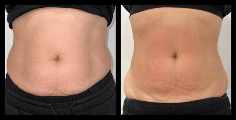 Before and after image of Ultrasound Body Contouring showing visible inch loss and body sculpting results after 1 treatment – courtesy of Amore Body Lab, Applecross, WA.
