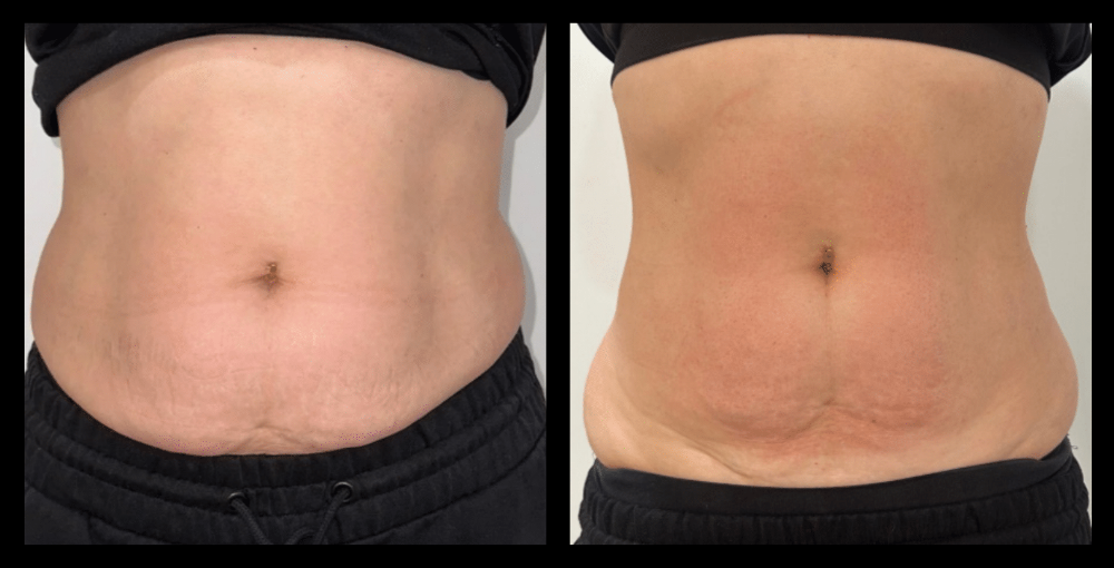 Before and after image of Ultrasound Body Contouring showing visible inch loss and body sculpting results after 1 treatment – courtesy of Amore Body Lab, Applecross, WA.