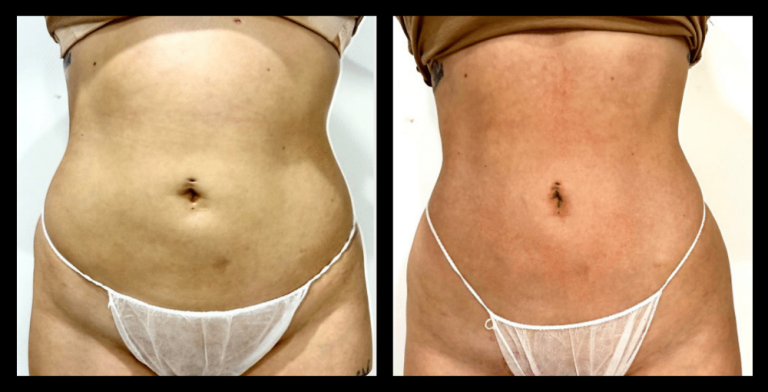 Before and after image of Ultrasound Body Contouring showing visible inch loss and body sculpting results after 1 treatment – courtesy of Amore Body Lab, Applecross, WA.