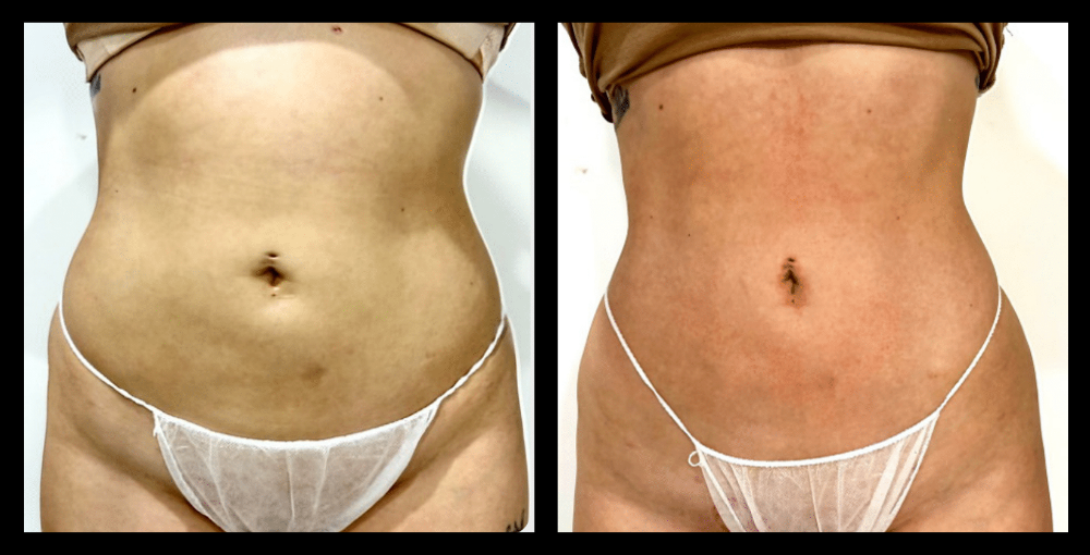 Before and after image of Ultrasound Body Contouring showing visible inch loss and body sculpting results after 1 treatment – courtesy of Amore Body Lab, Applecross, WA.