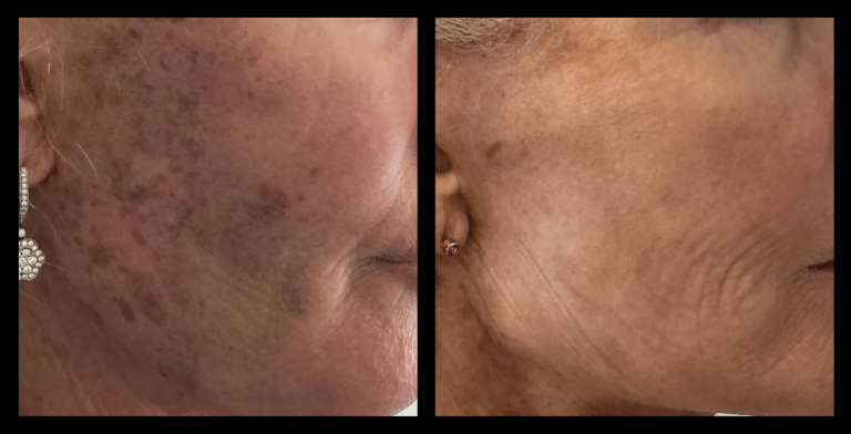 IPL Pigmentation Correction Results After 3 Treatments. Photo Courtesy of 23 Therapies, Pukekohe, Auckland, New Zealand.
