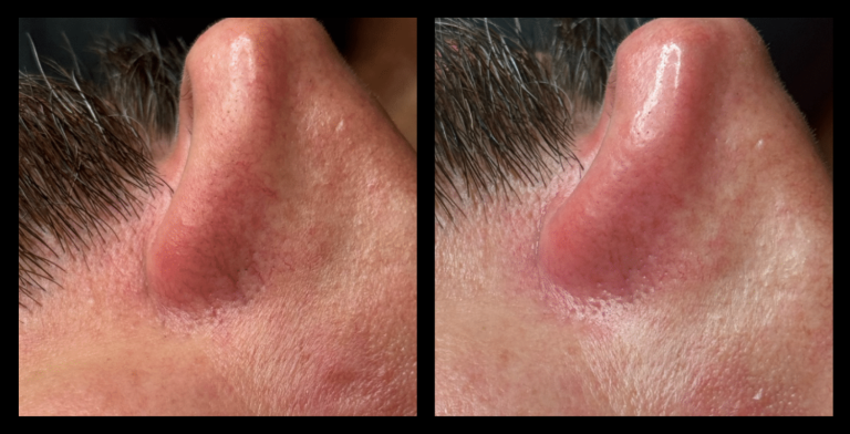 IPL Vascular Therapy Results After 1 Treatment. Photo Courtesy of Lush Culture Bendigo, Bendigo, VIC.