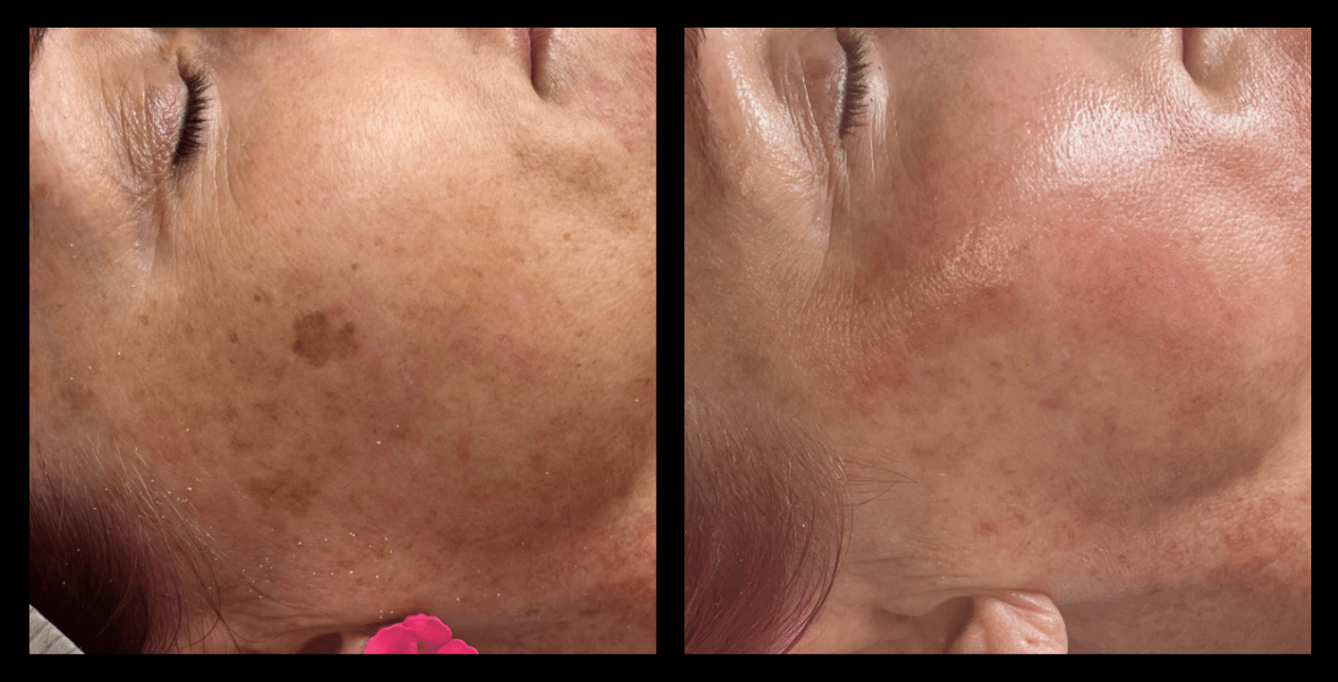 IPL Pigmentation Correction before and after photo showing improved skin clarity and reduced dark spots after 3 treatments. Courtesy of Lunarlux Skin & Laser, Mudgeeraba, Queensland.