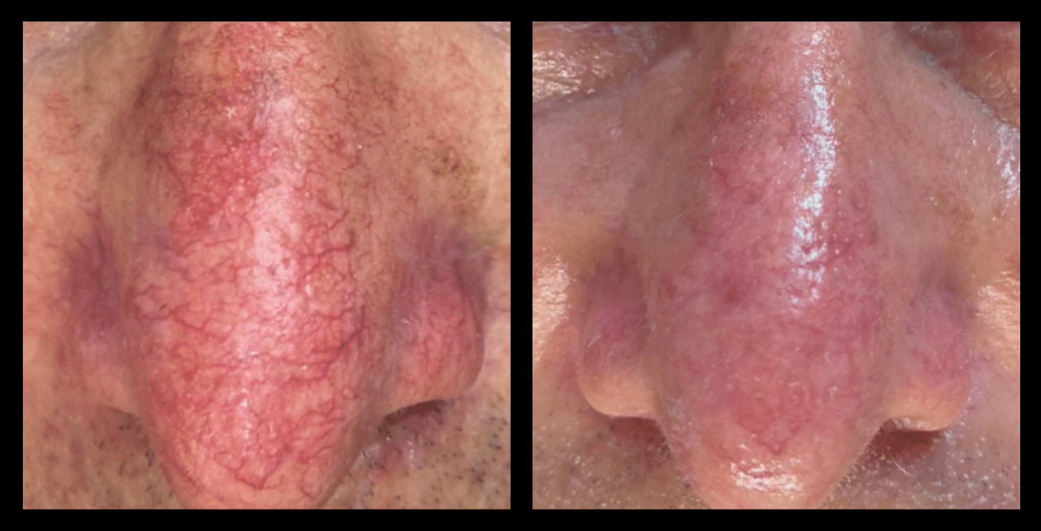 IPL Vascular Therapy Results After 3 Treatments. Photo Courtesy of Lunarlux Skin & Laser, Mudgeeraba, Queensland.